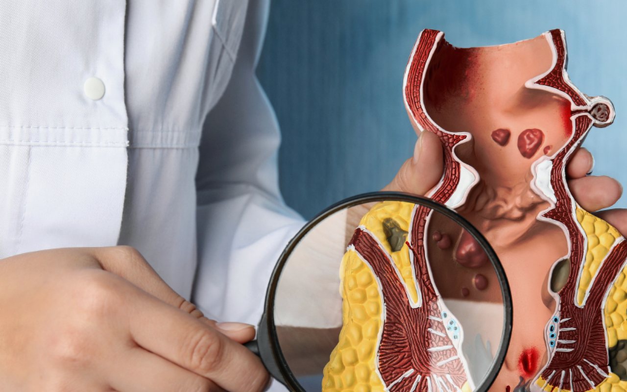 Cirugía de hemorroides en Tijuana con el Dr. Ari Salvador Salgado Rodríguez